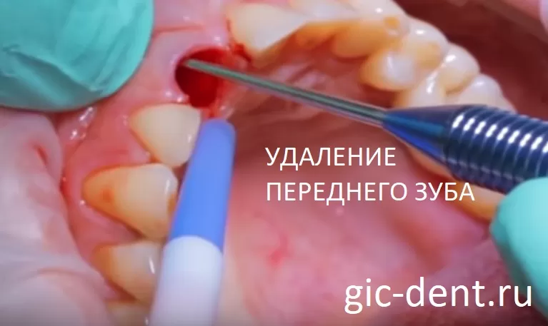 Удаление переднего зуба